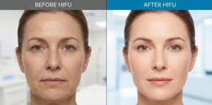 مراقبت‌های بعد از هایفو