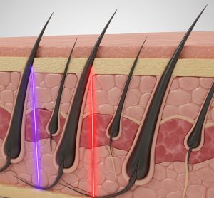 لیزر-سه-طول-موج-چگونه-کار-میکند